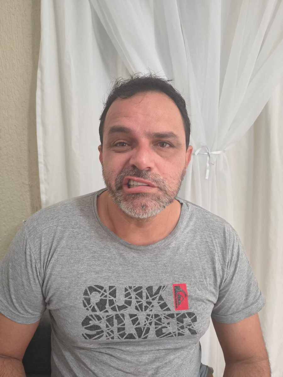 Paciente com paralisia de Bell antes do tratamento, com assimetria facial evidente